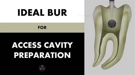 which type of bur is used to remove decay during tooth preparation.